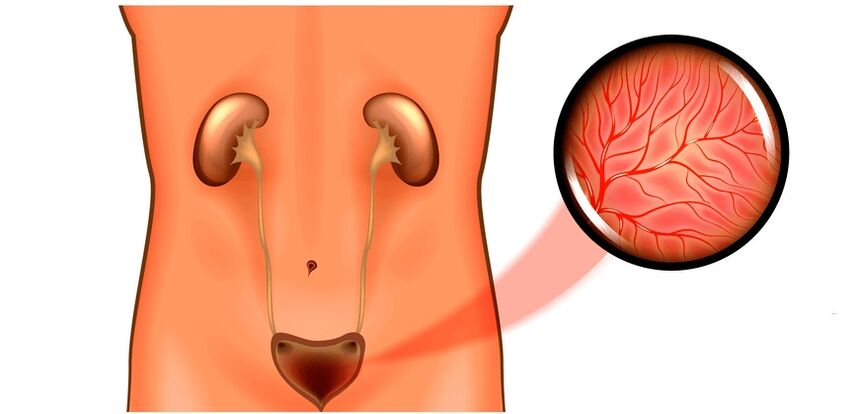 Cystitis in symptoms and treatment for men