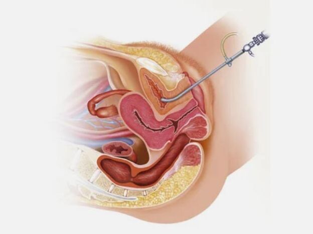 Cystitis diagnosis